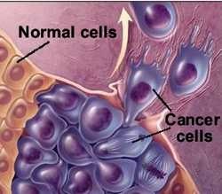 Cellule tumorali